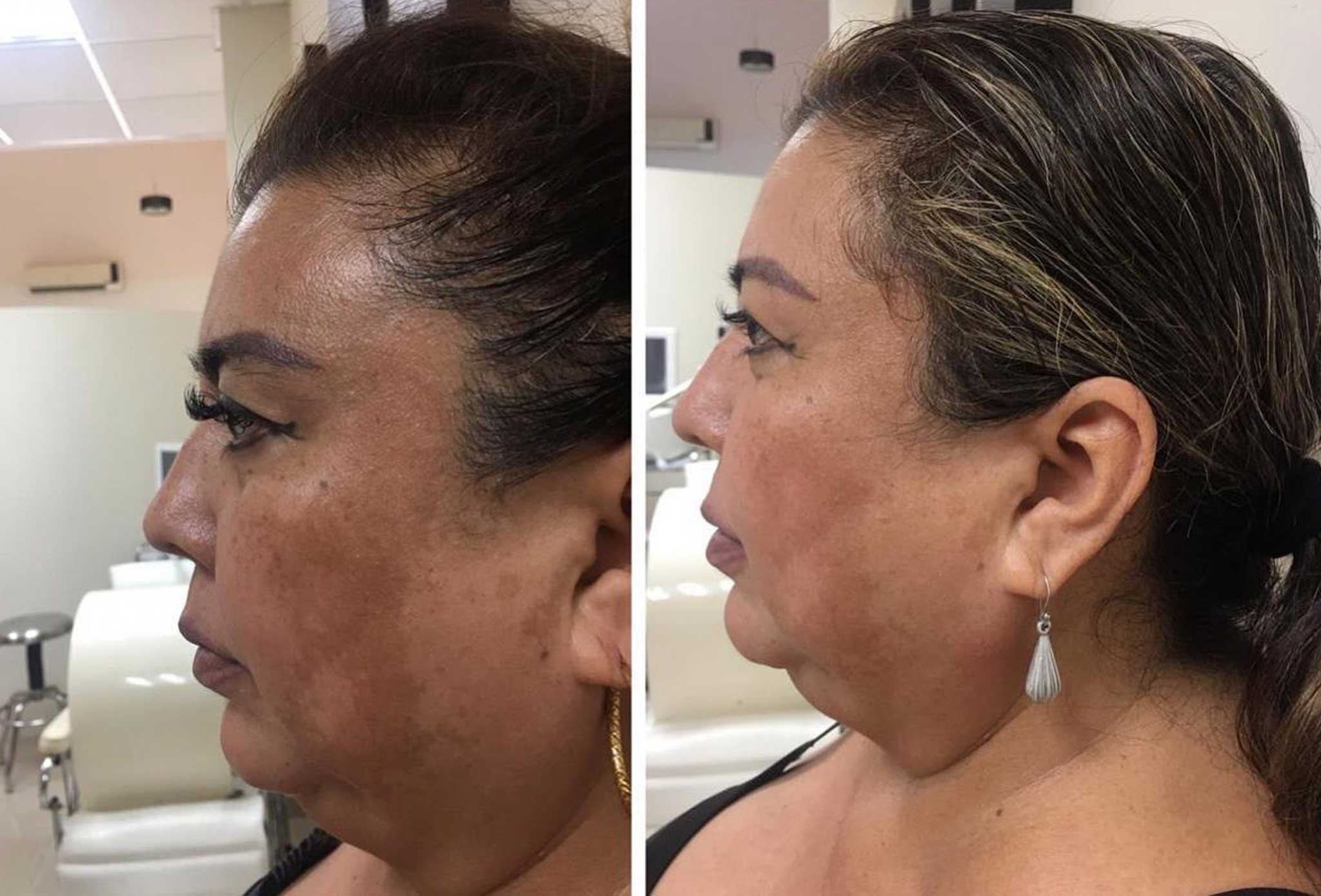 HIFU-cuello